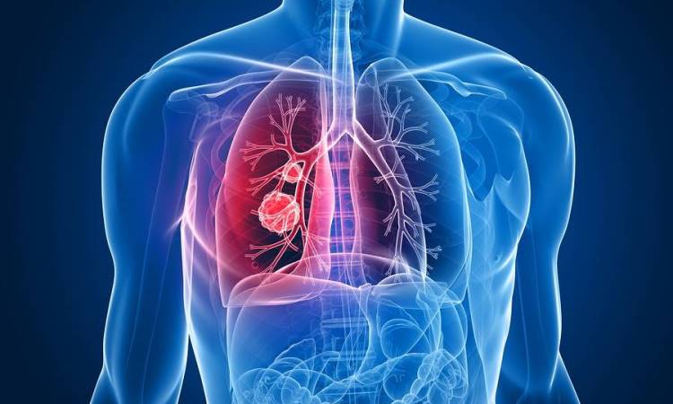 Do You Have Asbestos-Related Cancer?