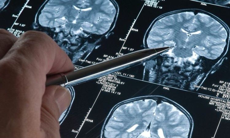 Five Steps To An Alzheimer Cur